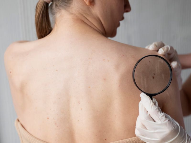 tsiogkaderma dermatologiko