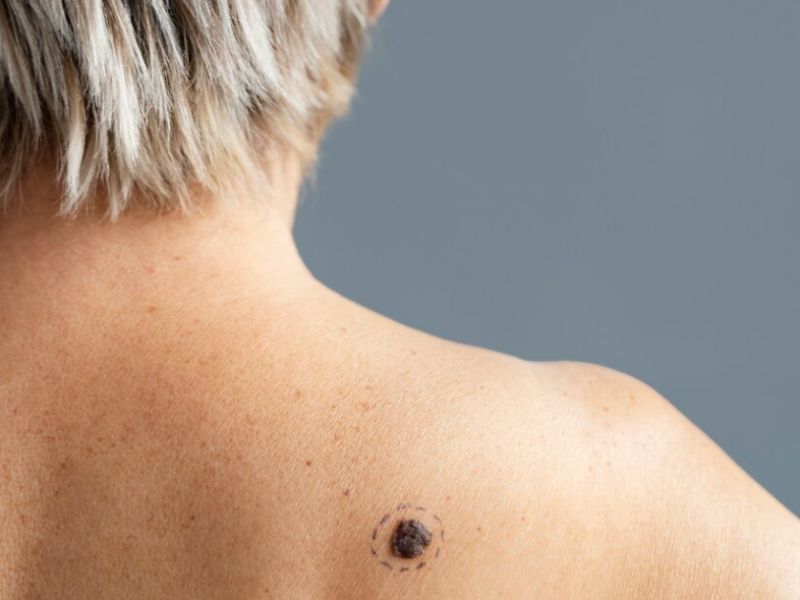 antimetopisi karkinou