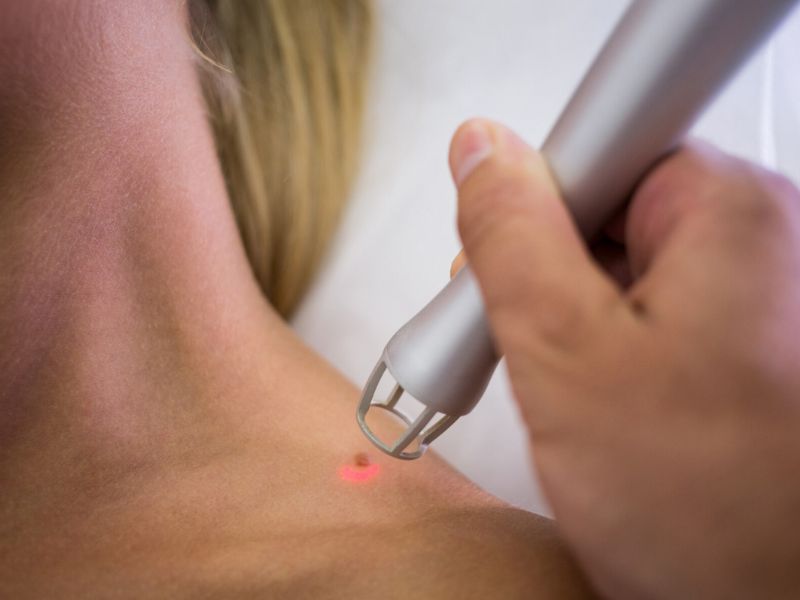 antimetopisi karkinoy dermatos